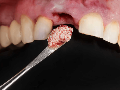 Bone grafts in surgical dentistry cover