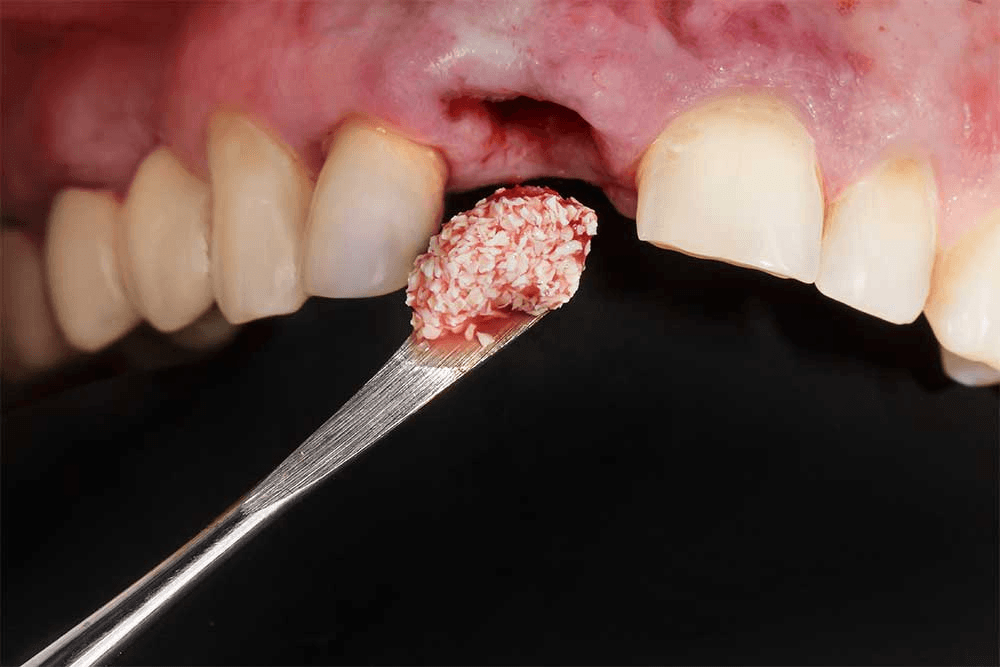 Bone grafts in surgical dentistry cover