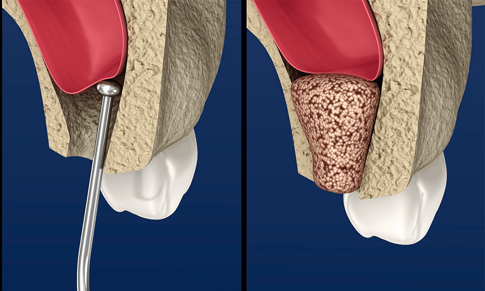 Principles, Harvesting & Healing of Bone Grafts in Dental Implant Cases cover
