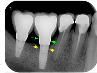 Less Screw Loosening, More Implant Success- A Recent Analysis. cover