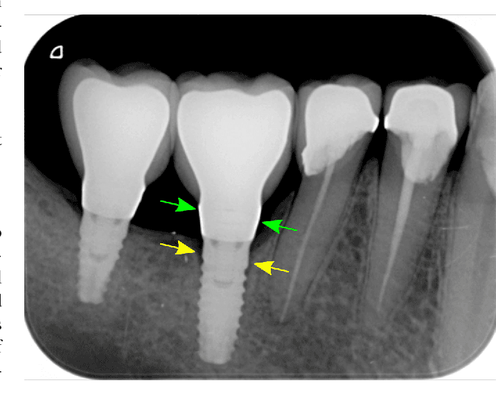 Less Screw Loosening, More Implant Success- A Recent Analysis. cover