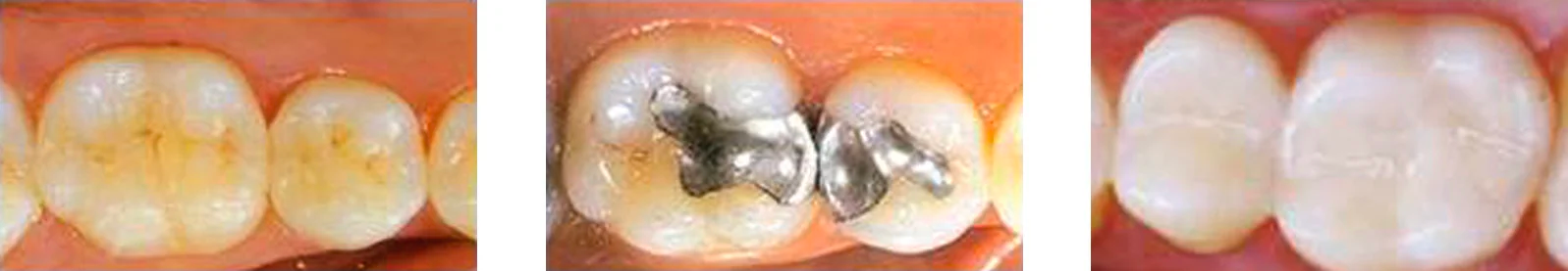 Measuring the Effect of Polymerization on Dental Composites cover